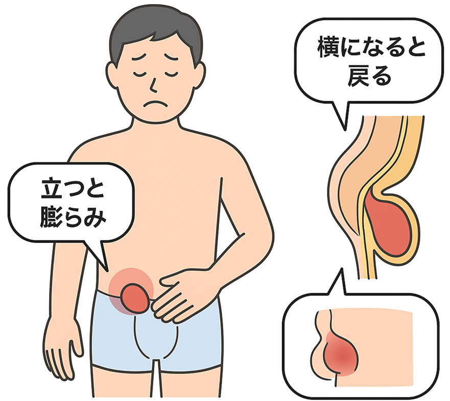 鼠径ヘルニアとは