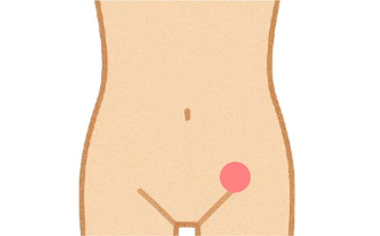 外鼠径ヘルニア