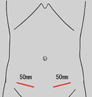 鼠径部切開法の手術創